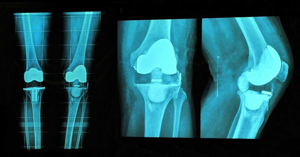 Endoproteza kolana a fizjoterapia – rekomendacje oparte na doniesieniach naukowych